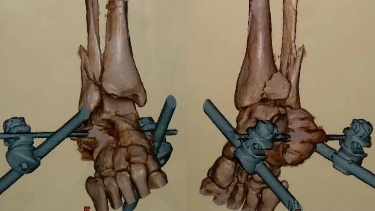 脱臼骨折の様子を写したMRI画像